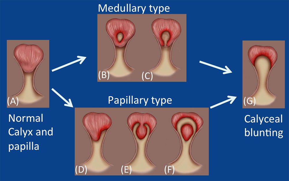Papillary Necrosis